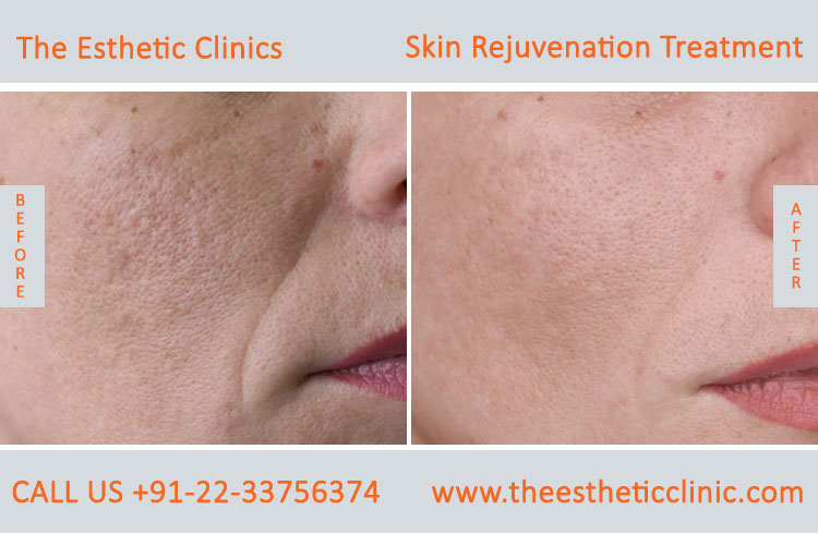 Skin Rejuvenation whitening lightening Laser Treatment before after photos in mumbai india (6)